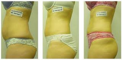 Before and After - Weight Loss Treatment in Stamford, CT