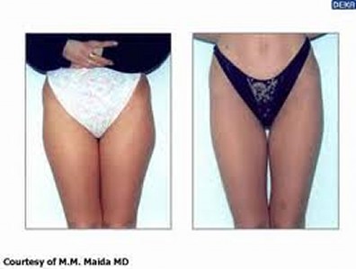 Before and After - Weight Loss Treatment in Stamford, CT