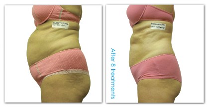 Before and After - Weight Loss Treatment in Stamford, CT
